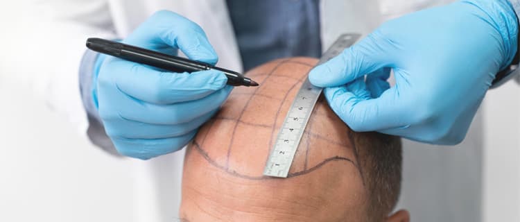 Türkei haartransplantation: Ein Leitfaden für die Vorbereitung und Genesung